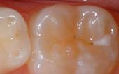 Pediatric Dentist - Tooth Before Sealant Application